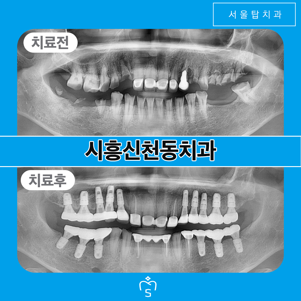 서울탑치과 임플란트