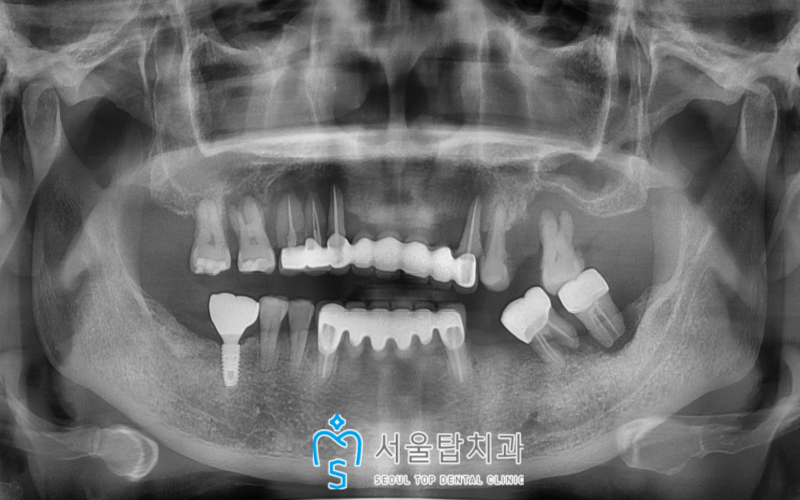 서울탑치과 임플란트