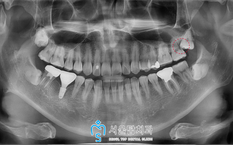 서울탑치과 임플란트