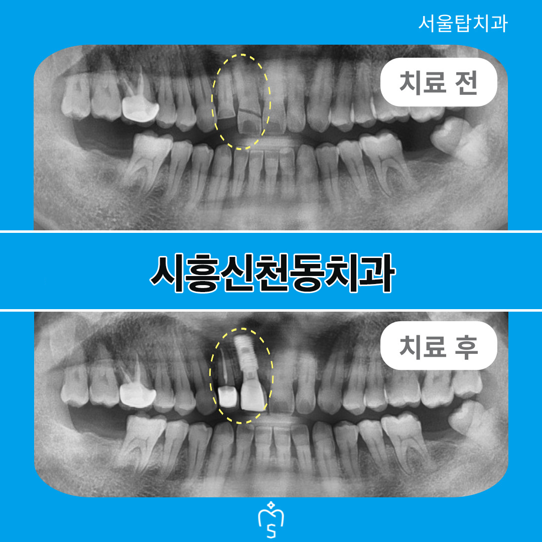 서울탑치과 임플란트