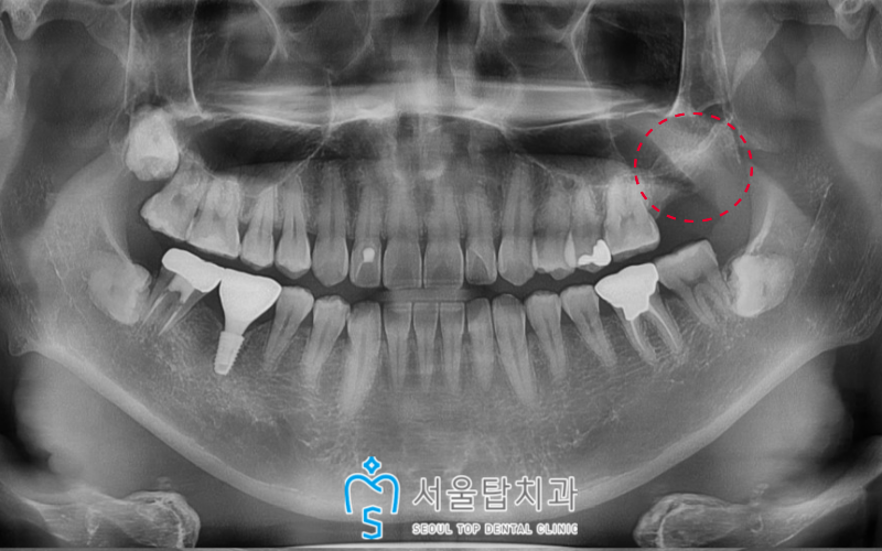 서울탑치과 임플란트
