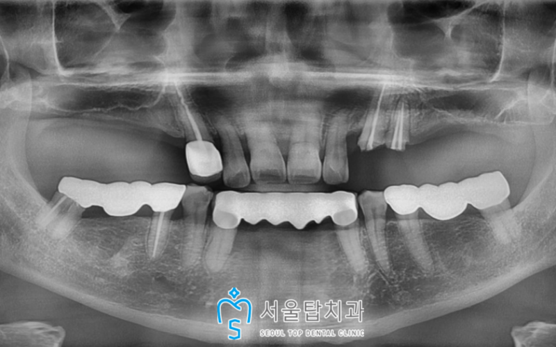 서울탑치과 임플란트