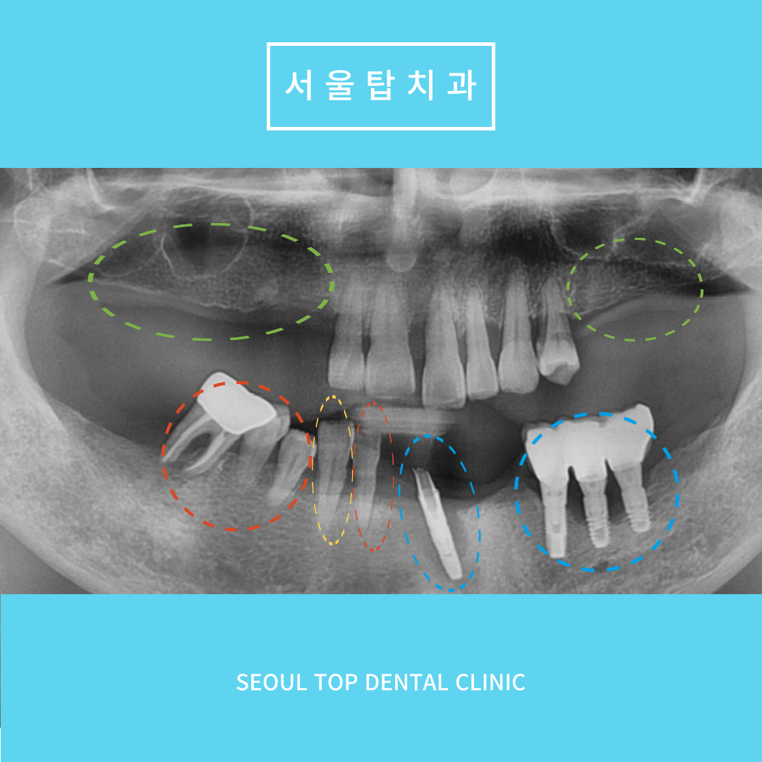 서울탑치과 임플란트