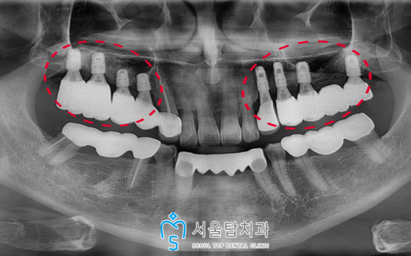서울탑치과 임플란트