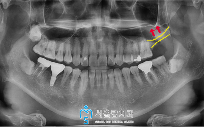 서울탑치과 임플란트