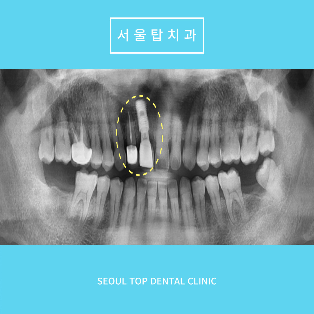 서울탑치과 임플란트
