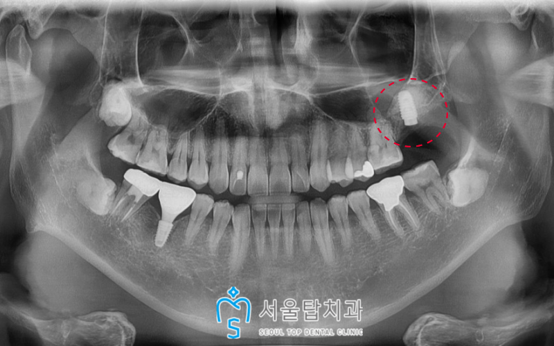 서울탑치과 임플란트