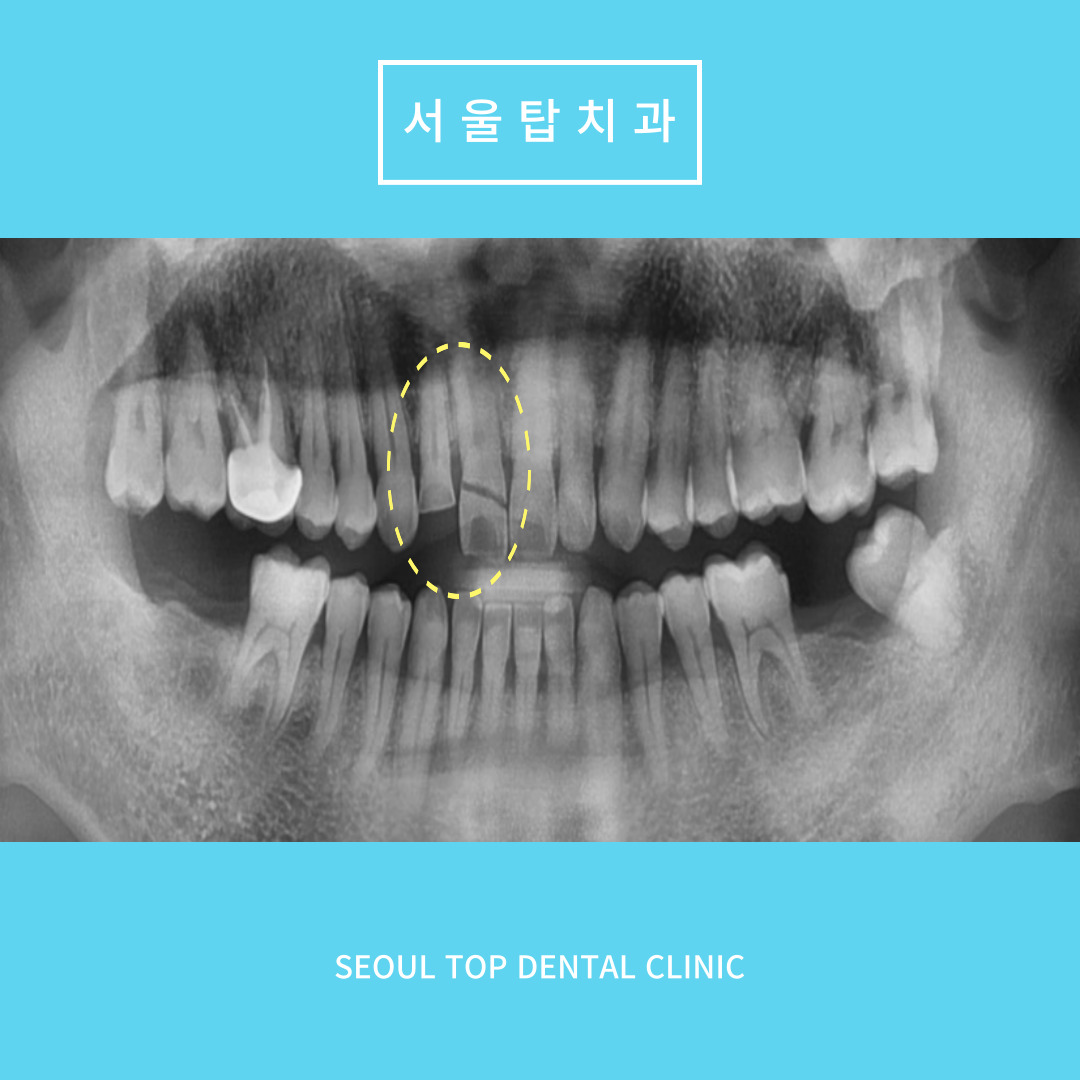 서울탑치과 임플란트