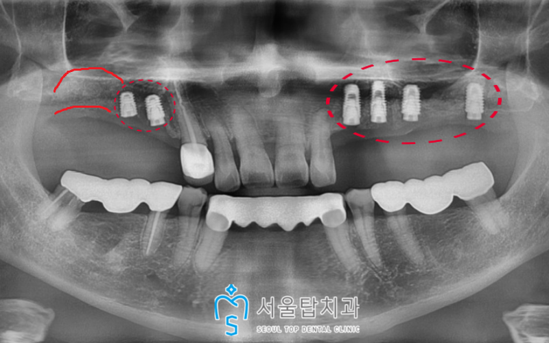 서울탑치과 임플란트