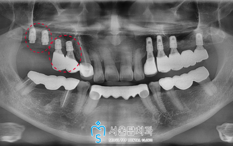 서울탑치과 임플란트