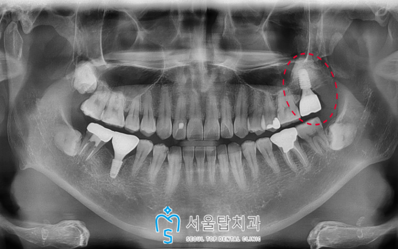 서울탑치과 임플란트