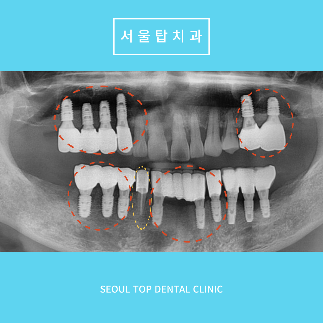 서울탑치과 임플란트