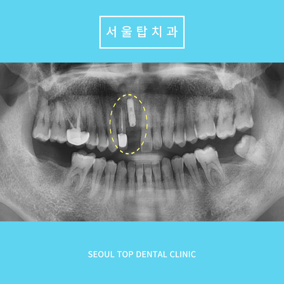 서울탑치과 임플란트