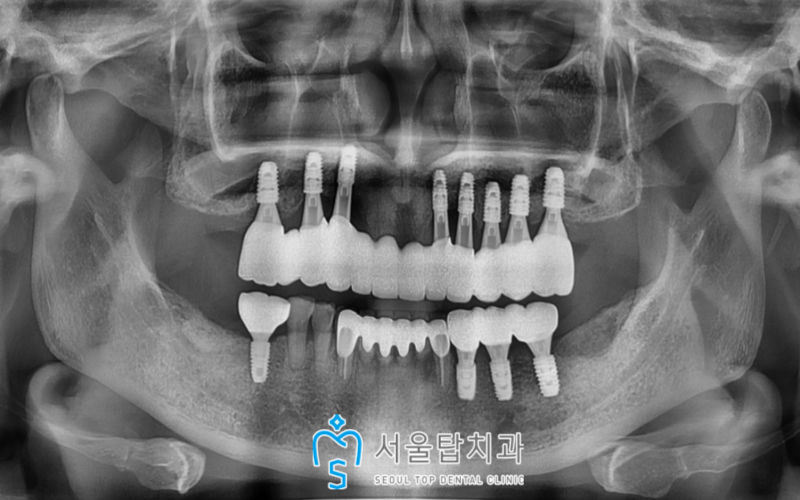 서울탑치과 임플란트
