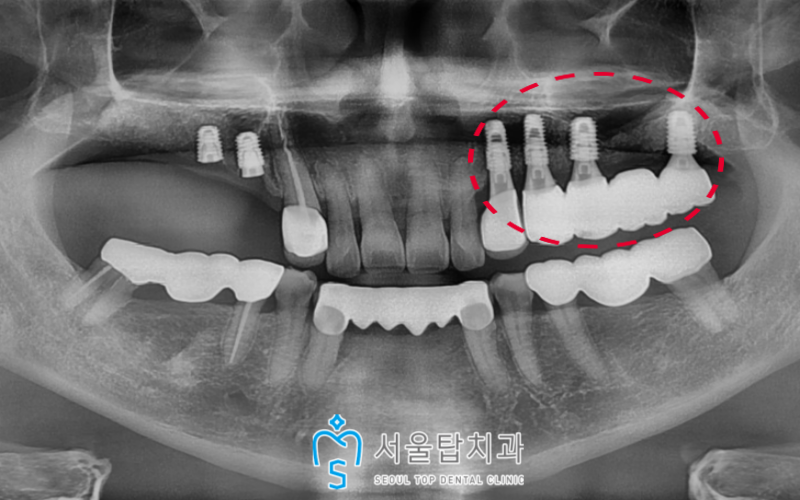 서울탑치과 임플란트