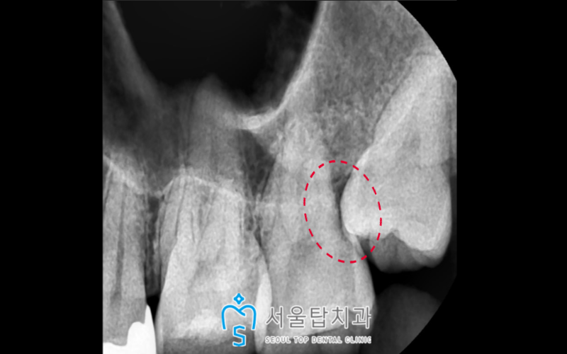 서울탑치과 임플란트