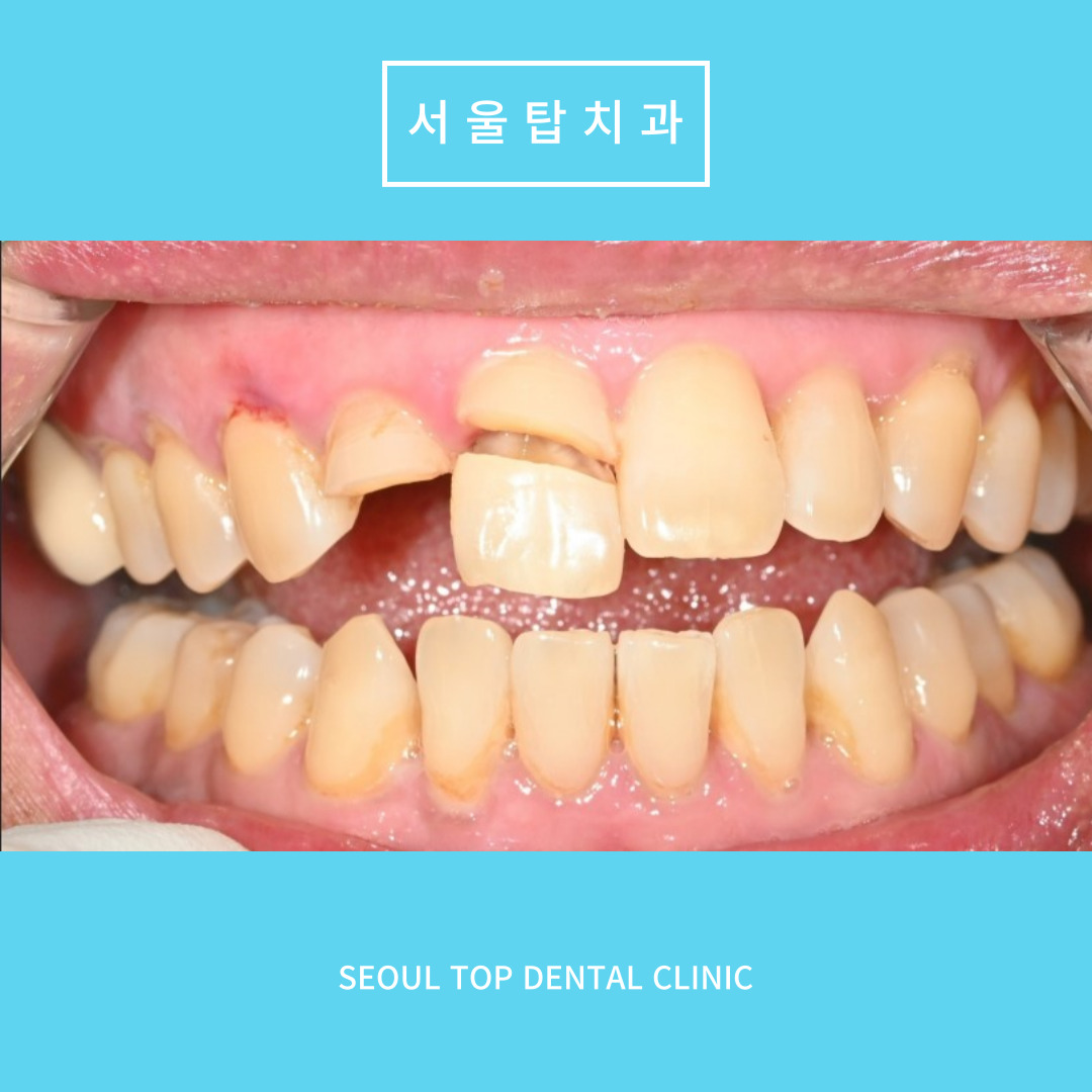 서울탑치과 임플란트