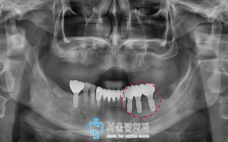 서울탑치과 임플란트