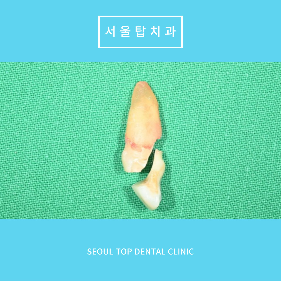 서울탑치과 임플란트