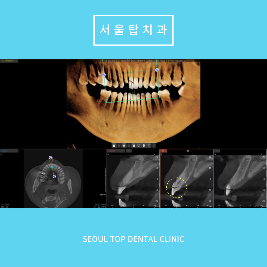 서울탑치과 임플란트