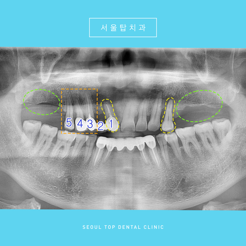 서울탑치과 임플란트