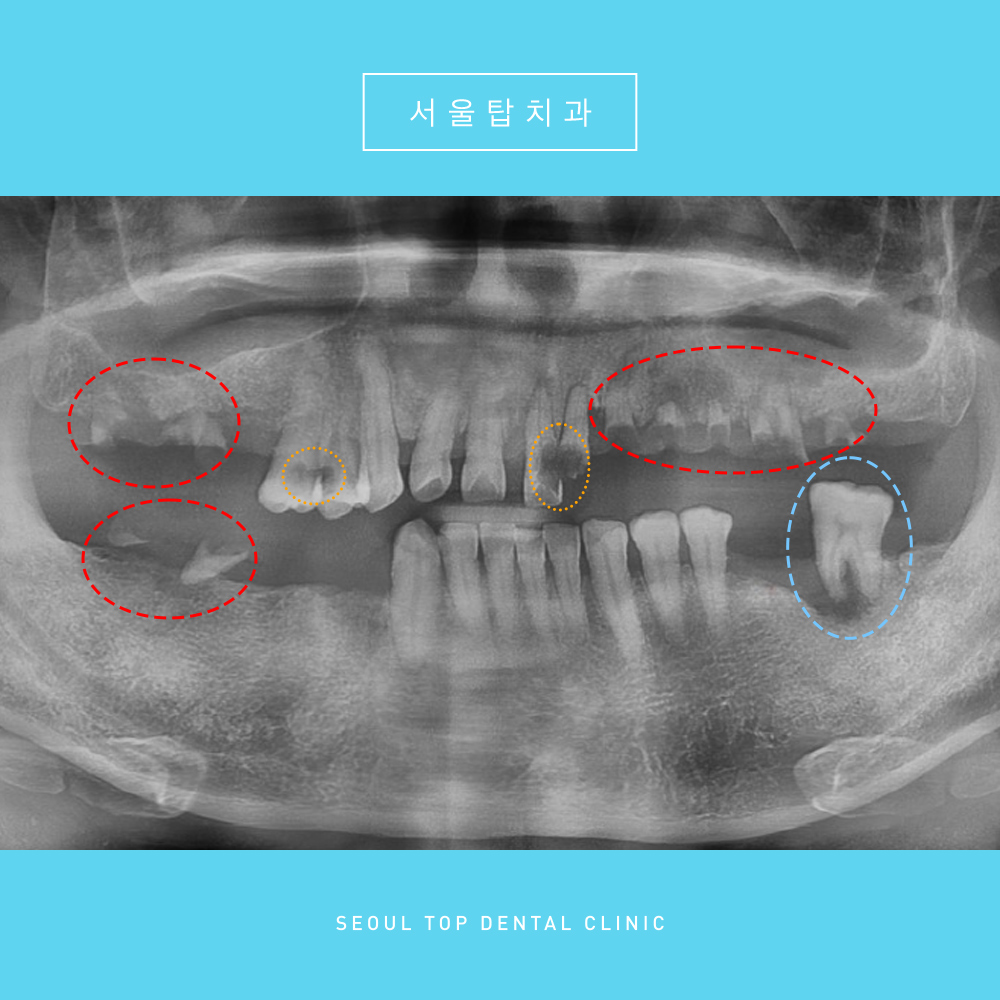 서울탑치과 임플란트