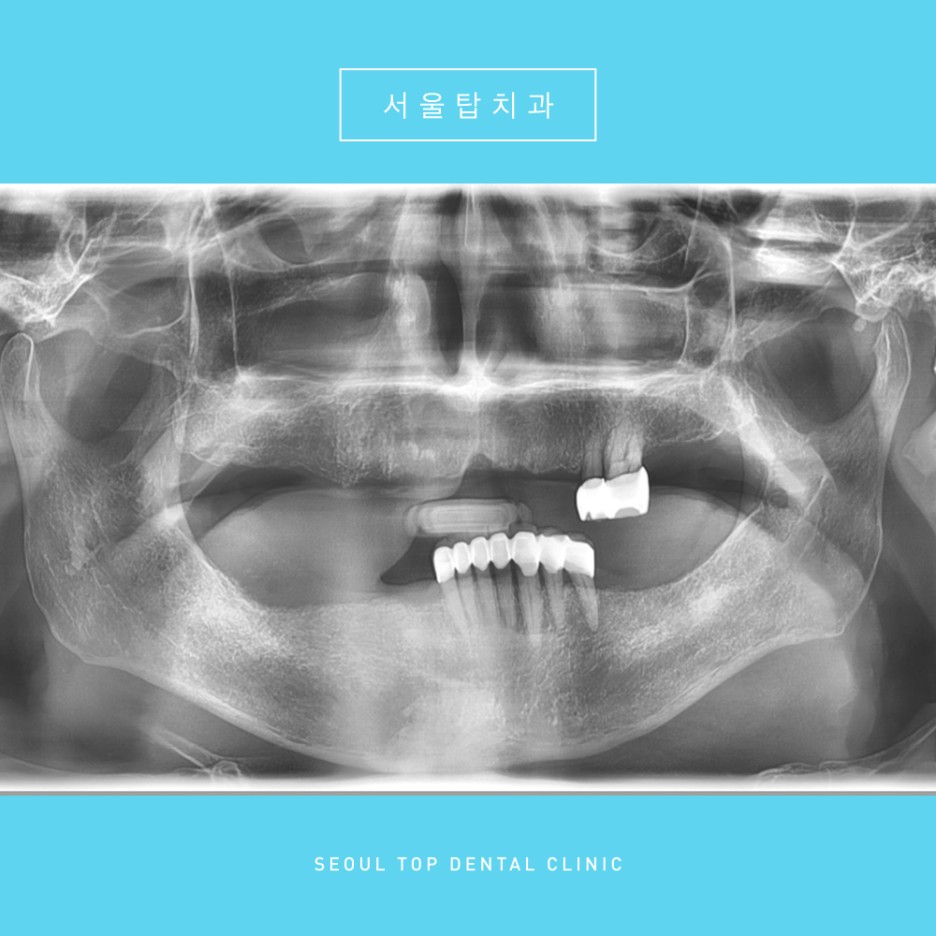 서울탑치과 임플란트
