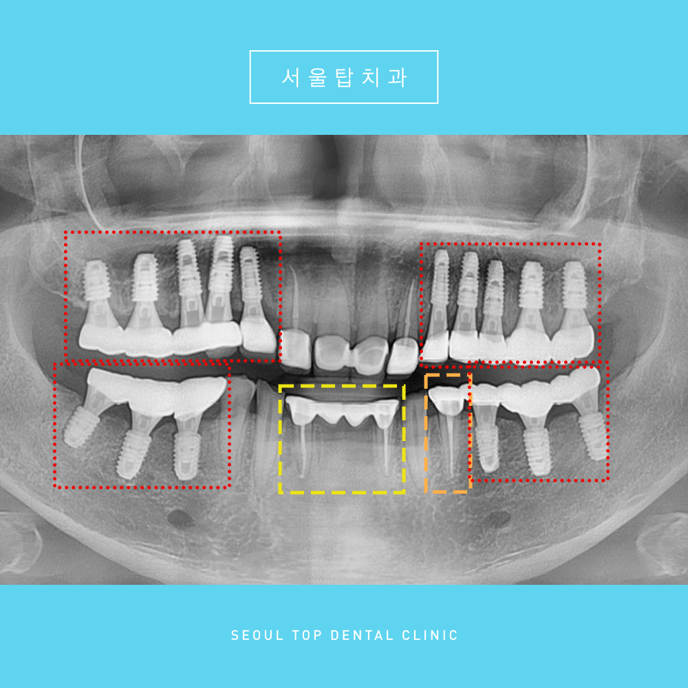 서울탑치과 임플란트