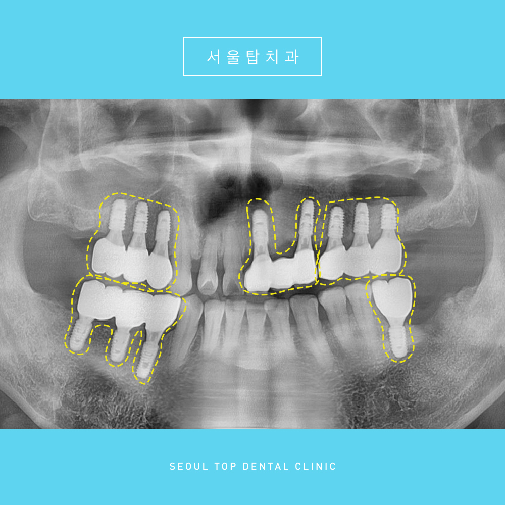 서울탑치과 임플란트