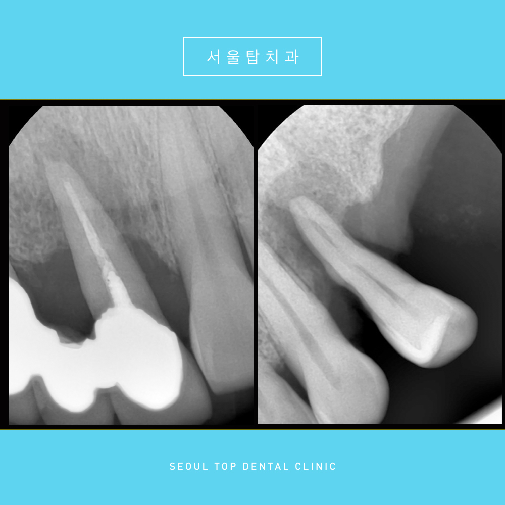 서울탑치과 임플란트
