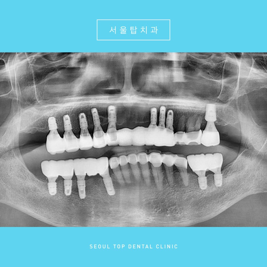 서울탑치과 임플란트