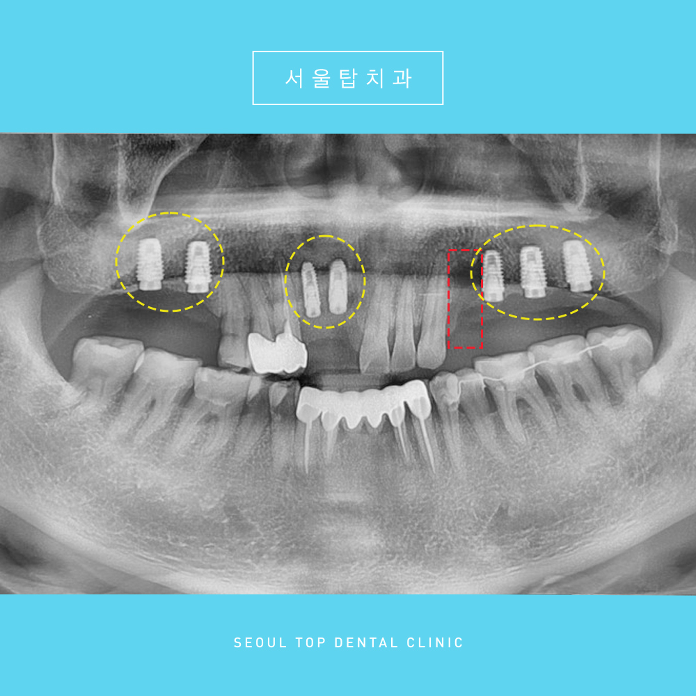 서울탑치과 임플란트