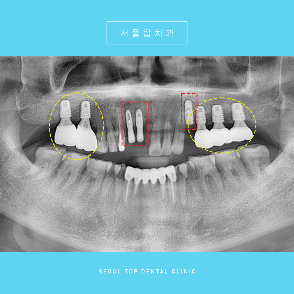 서울탑치과 임플란트