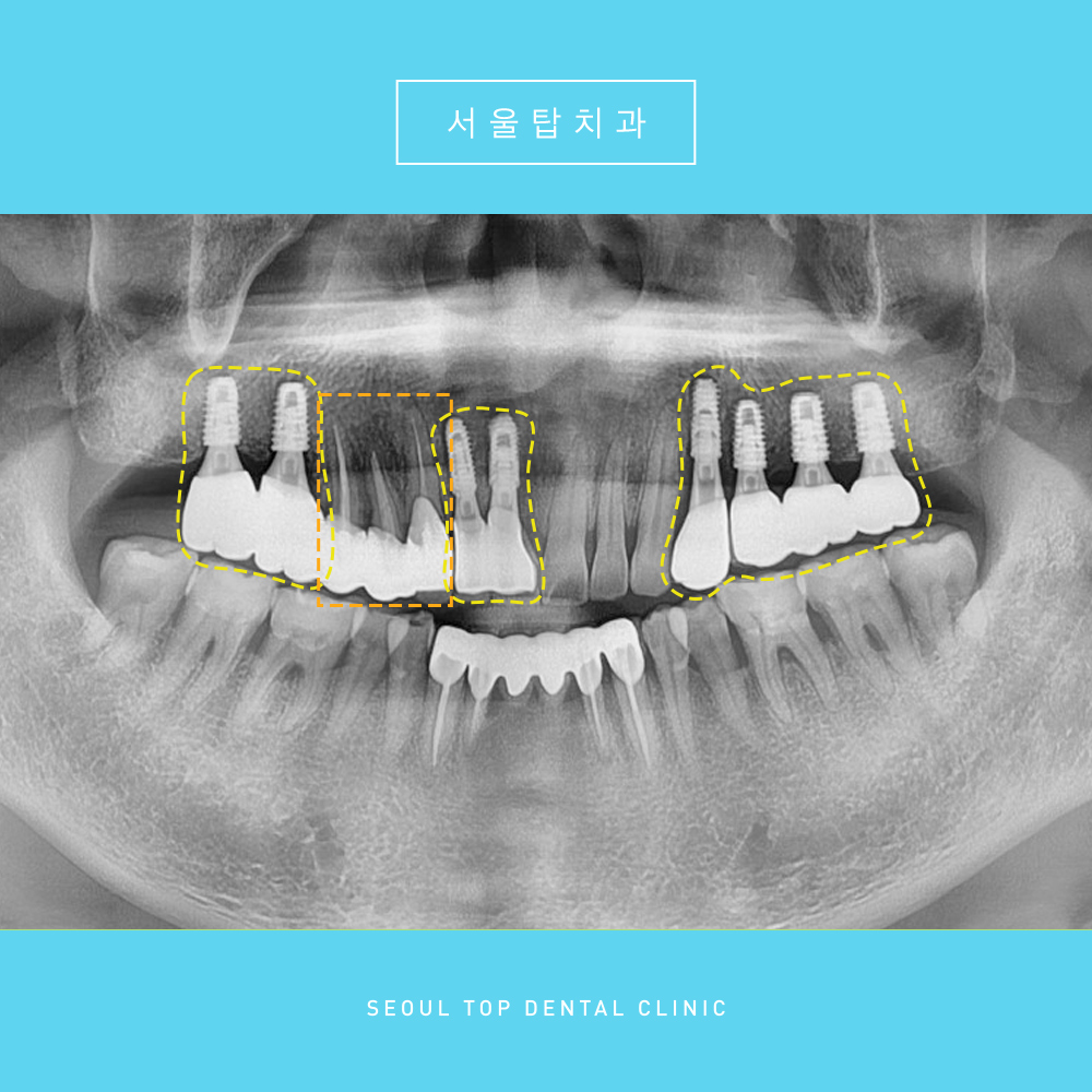 서울탑치과 임플란트