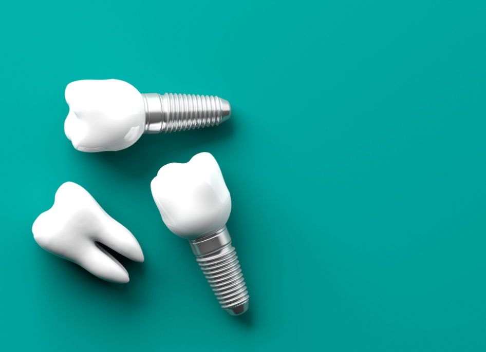 서울탑치과 임플란트