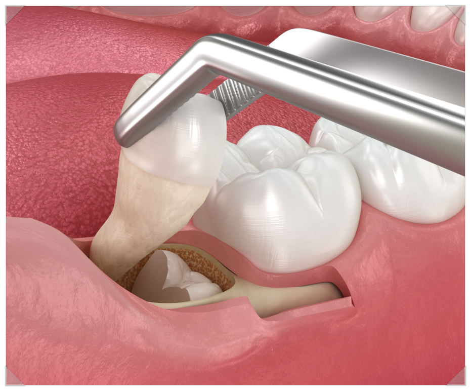 서울탑치과 사랑니발치