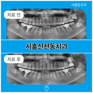 서울탑치과 임플란트