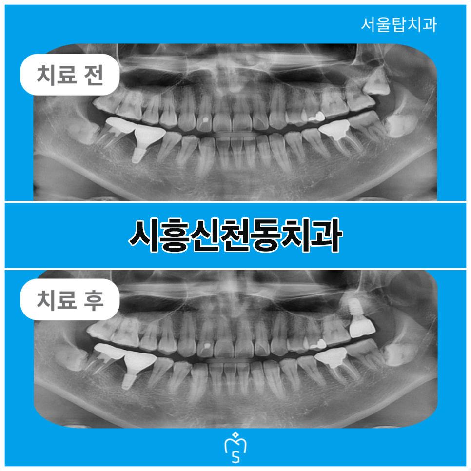 서울탑치과 임플란트