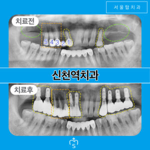 서울탑치과 임플란트