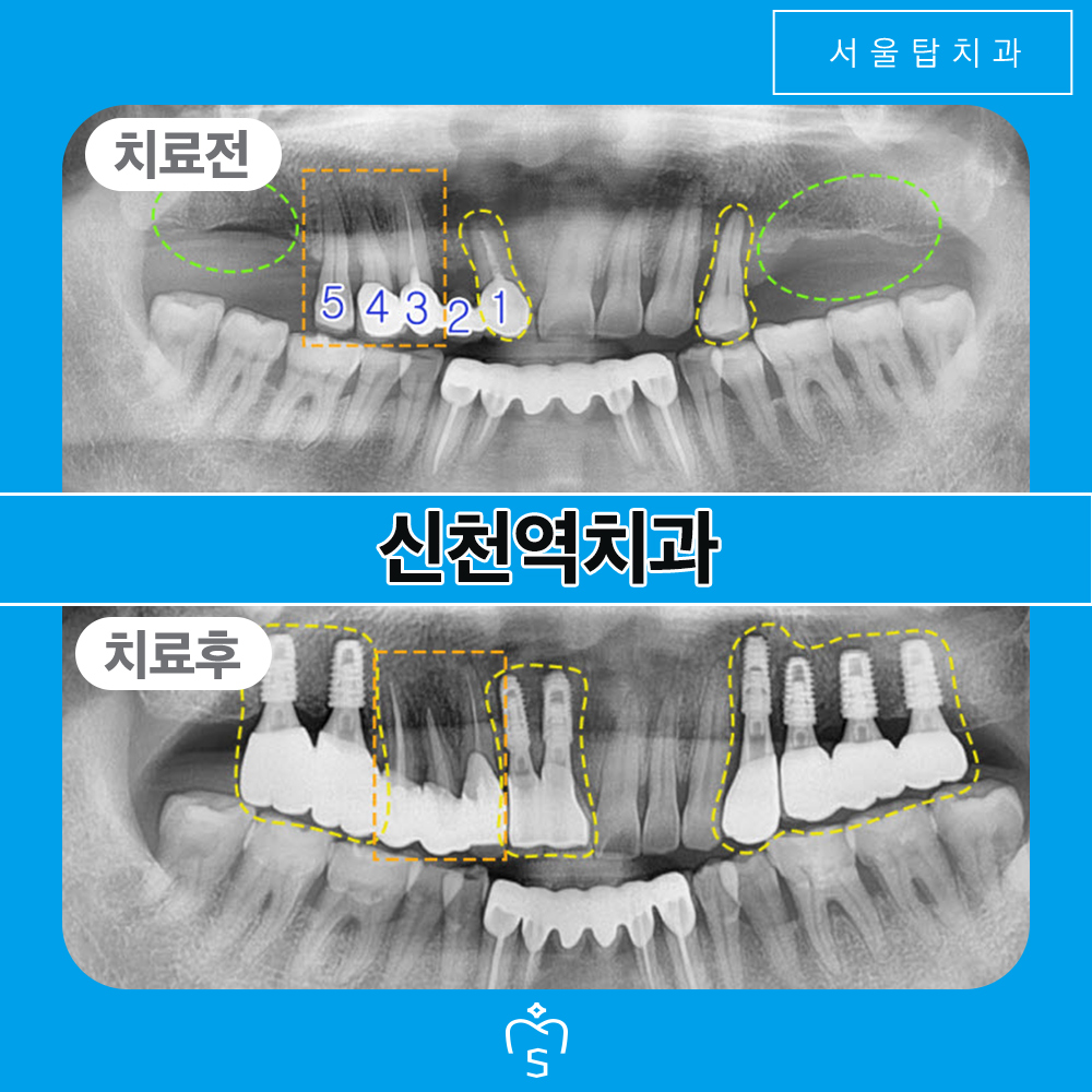 서울탑치과 임플란트