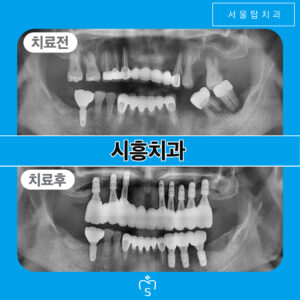 서울탑치과 임플란트