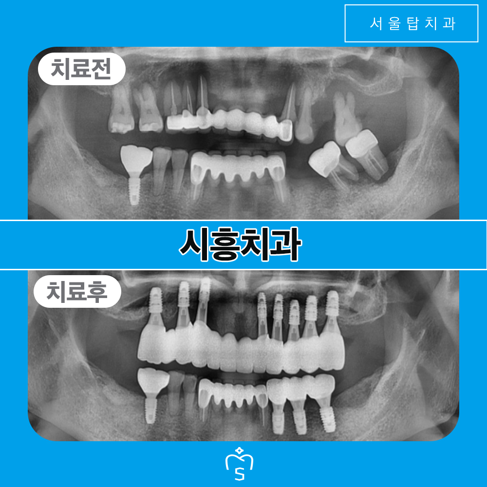 서울탑치과 임플란트