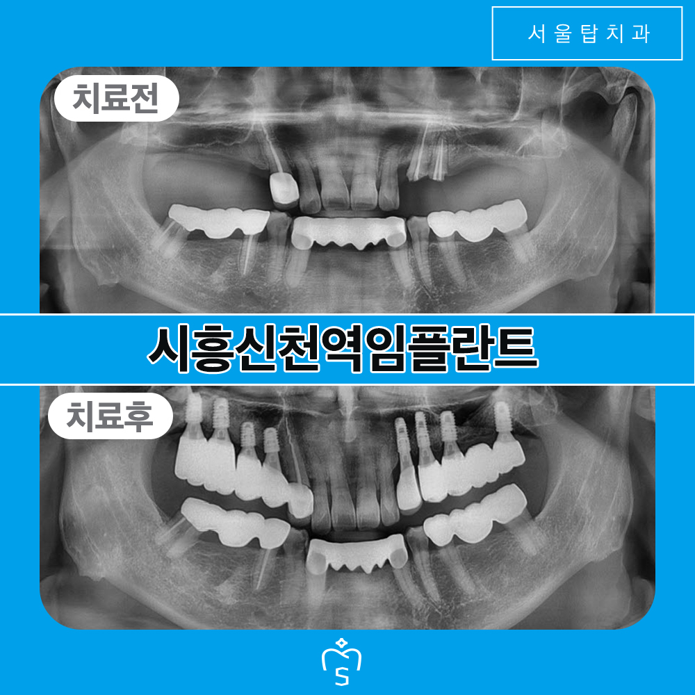 서울탑치과 임플란트