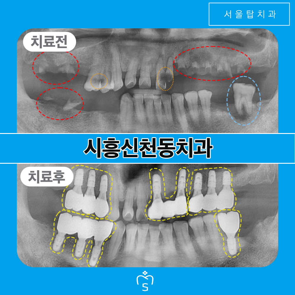 서울탑치과 임플란트