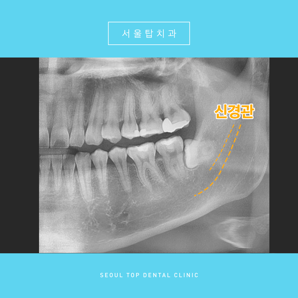 서울탑치과 사랑니발치