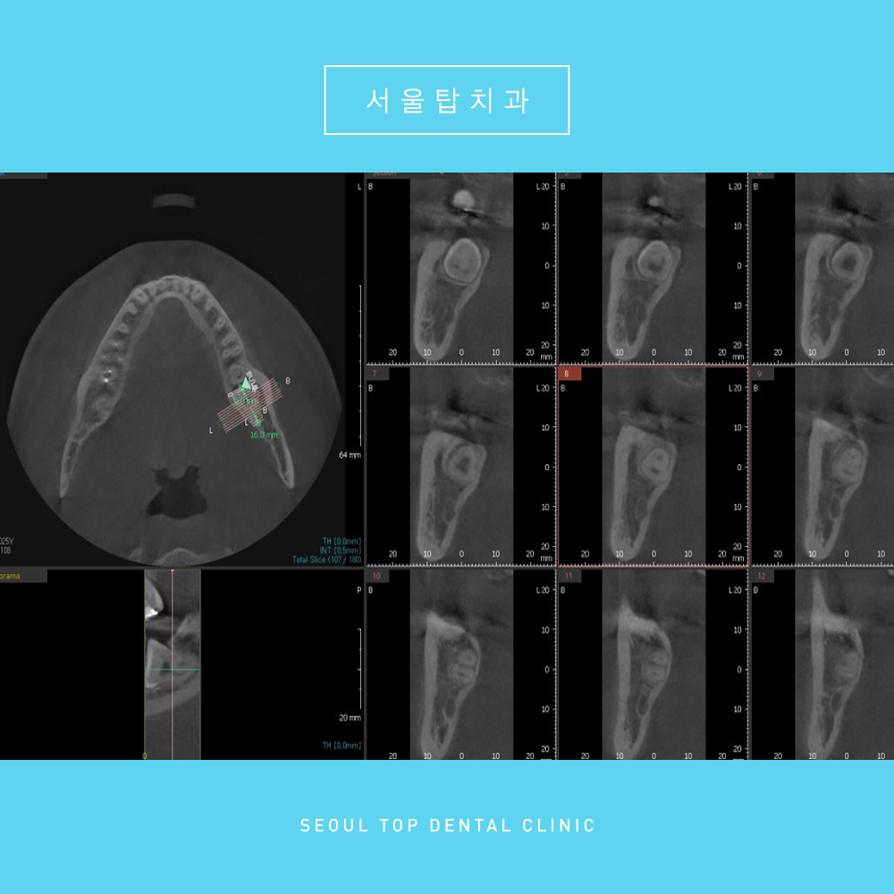 서울탑치과 사랑니발치