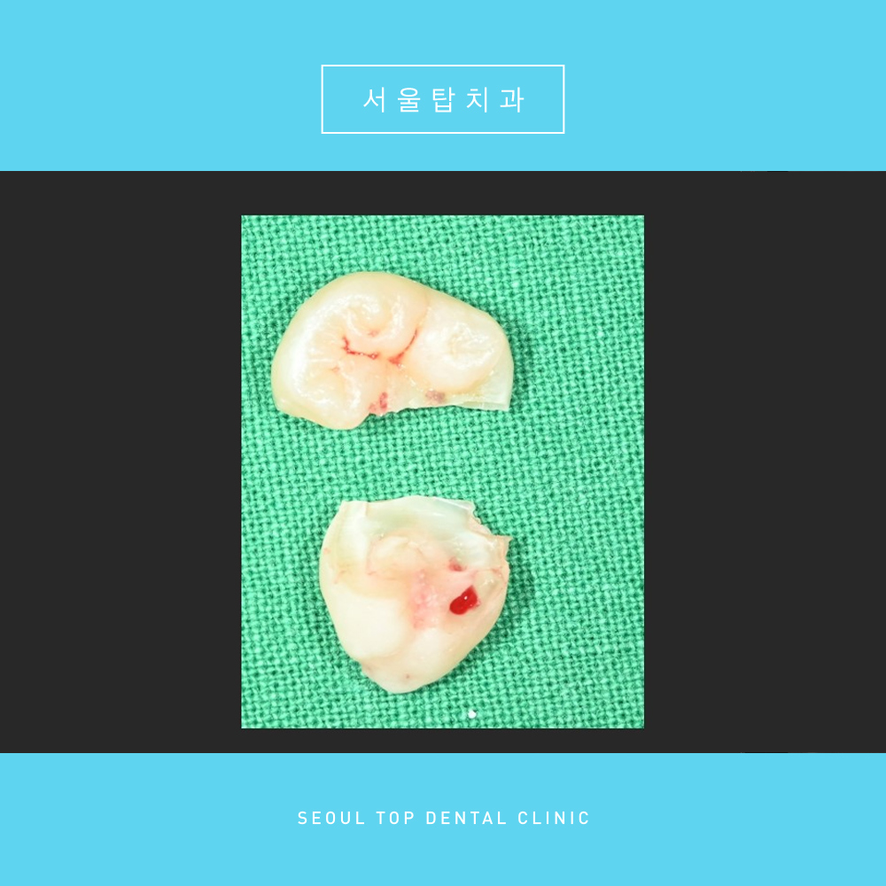 서울탑치과 사랑니발치