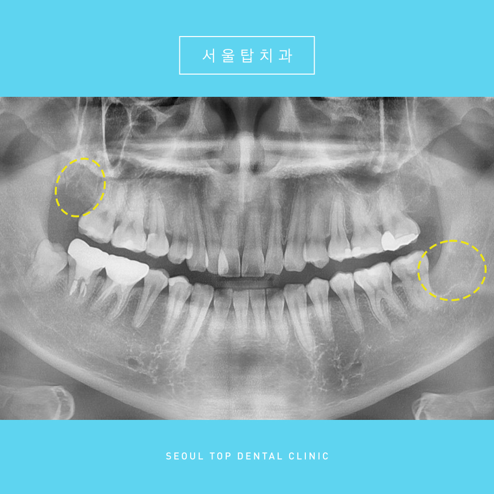 서울탑치과 사랑니발치