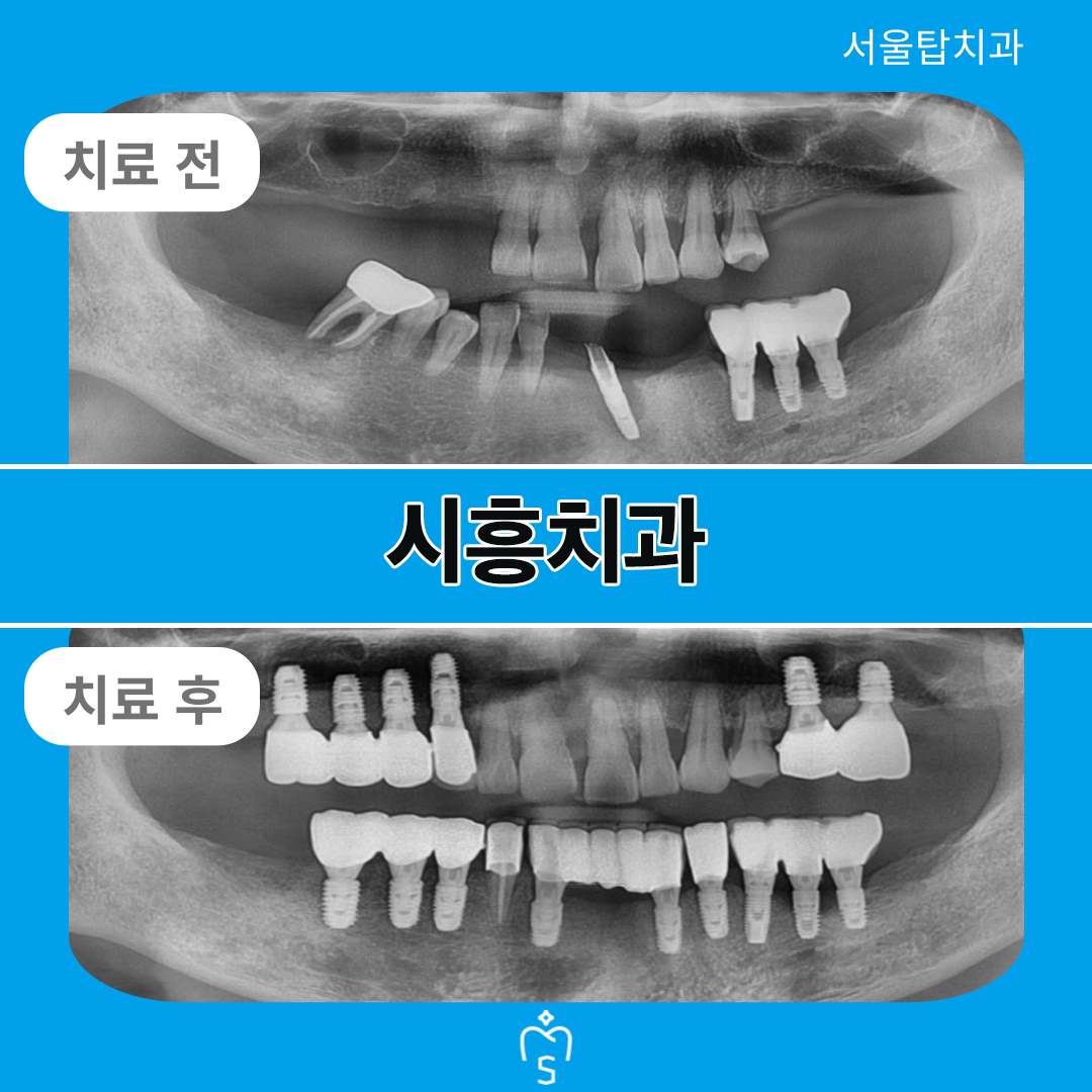 서울탑치과 임플란트
