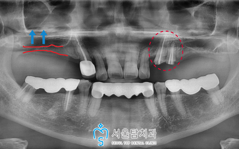 서울탑치과 임플란트